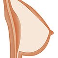 solid breast