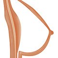 hollow breast